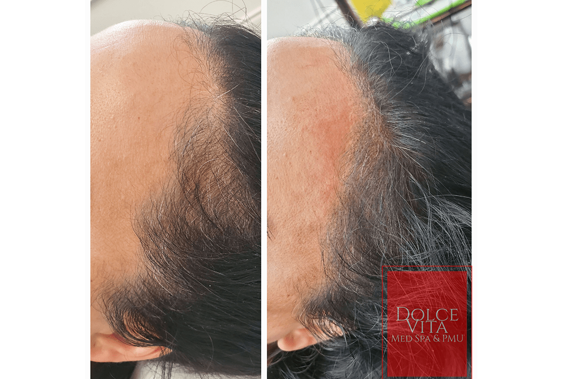 scalp pigmentation before and after
