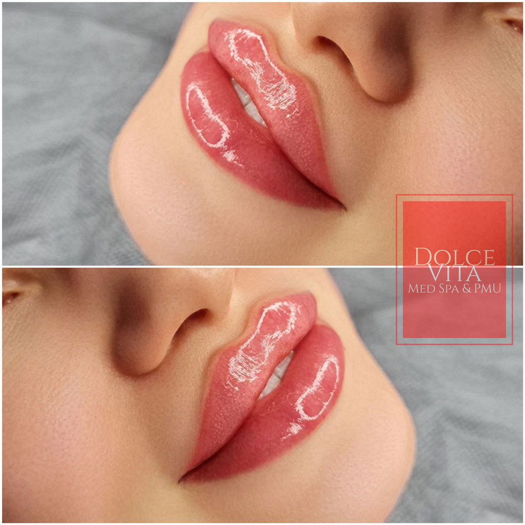 Lip Pigmentation