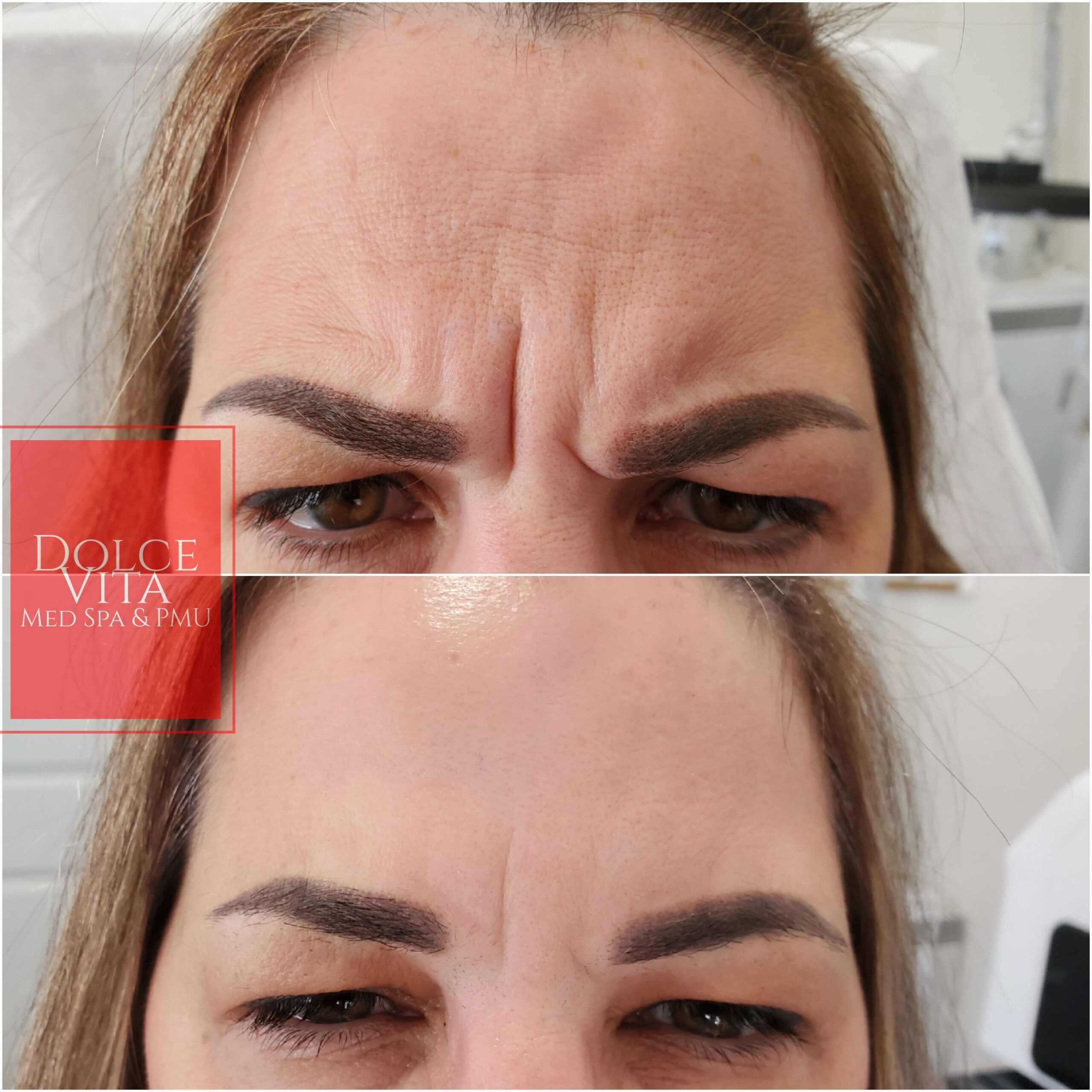 Botox Oakville